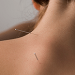 Acupuncture for Back Pain