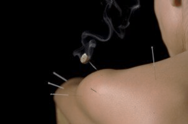 Acupuncture Benefits